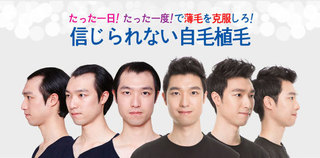 男性の植毛.jpg